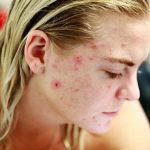 woman face acne