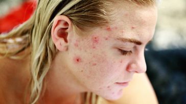 woman face acne