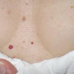 Cherry Angiomas: The Red Spots in Your Body and Why They Exist 2