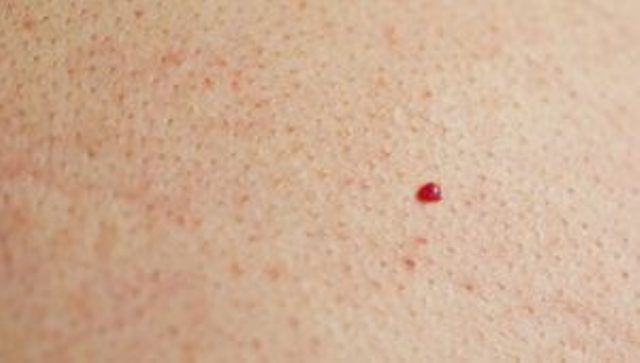 Cherry Angiomas: The Red Spots in Your Body and Why They Exist 2