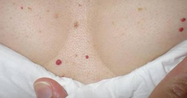 Cherry Angiomas: The Red Spots in Your Body and Why They Exist 1