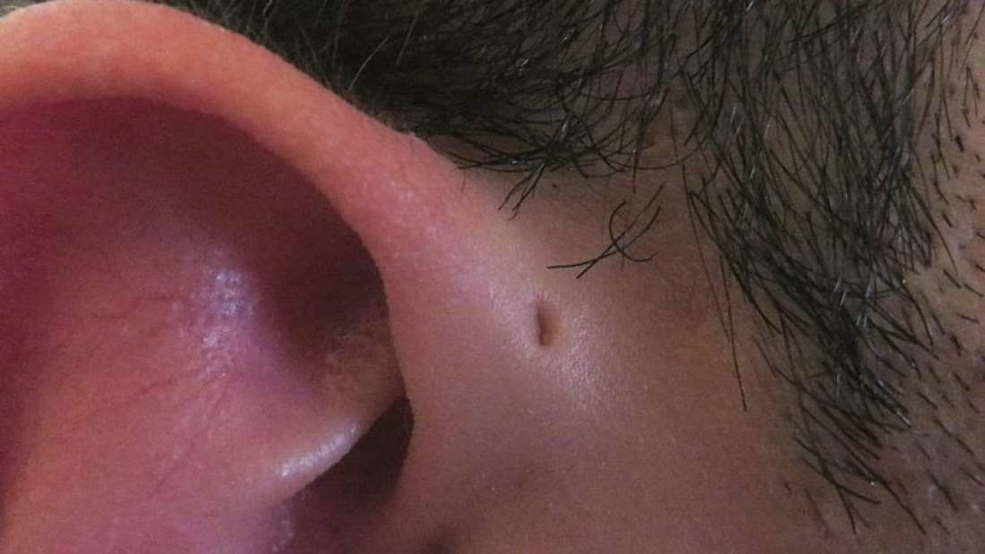 Preauricular Sinus extra hole ears